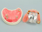 コーヌスアタッチメントの入れ歯